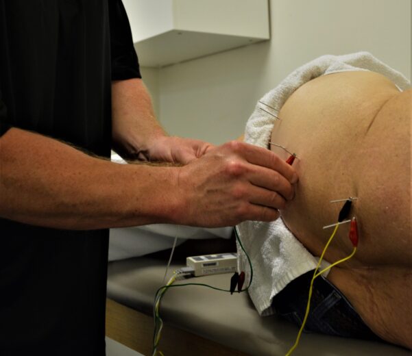 what is trigger point dry needling
